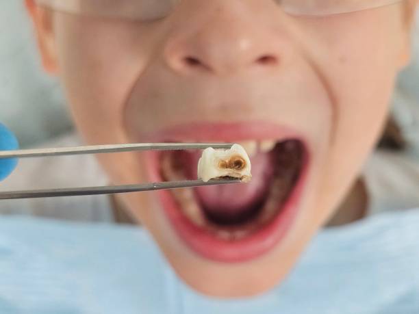 Best Urgent Care for Lost Fillings or Crowns in West Fork, AR